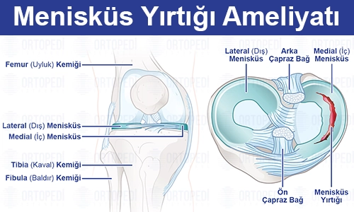 meniskus yirtigi